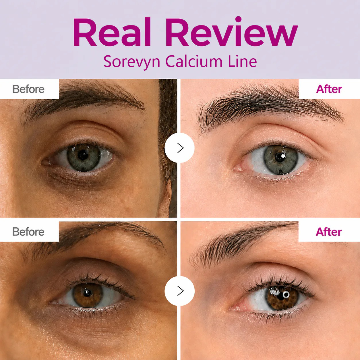 🔥LAST DAY 60% OFF!!Sorevyn Korean Calcium Dark Spot Eye Cream